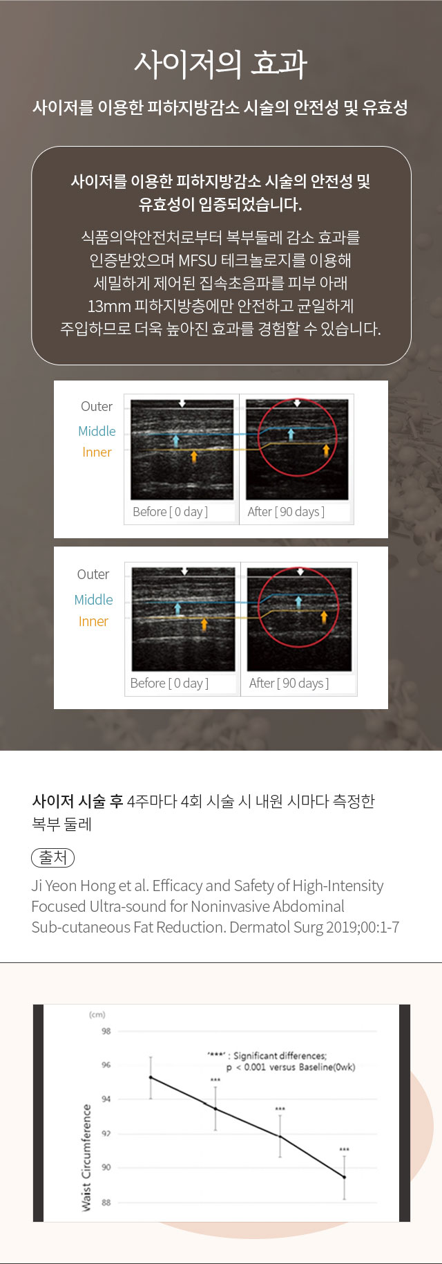 사이저 시술 효과